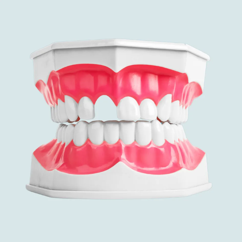 missing teeth